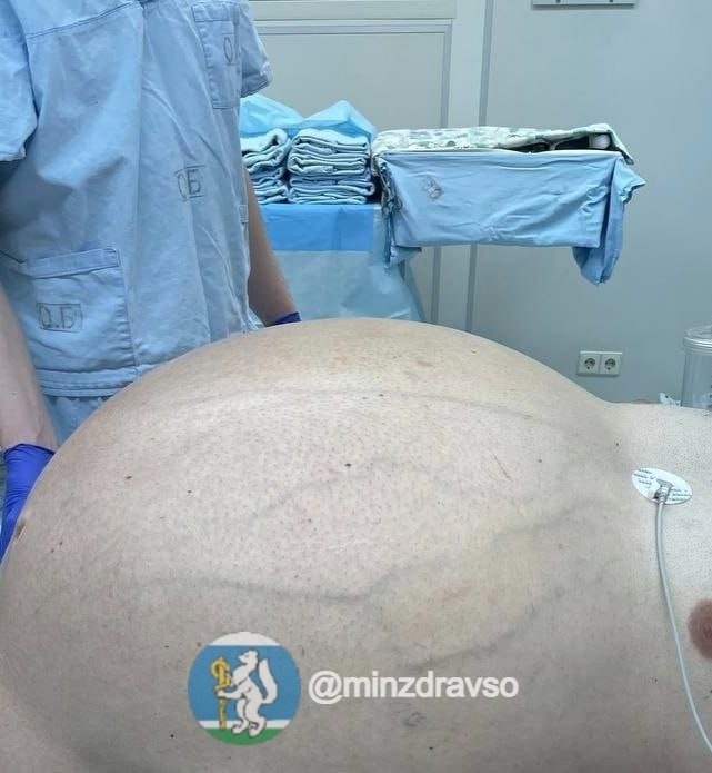 Если на первичном приёме вес пациента был около 150 килограммов, то спустя примерно месяц он достиг уже 180 килограммов. Фото: Минздрав Свердловской области 