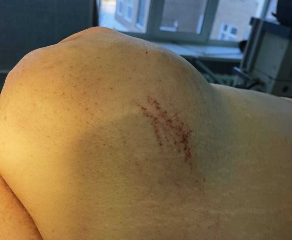    Врачам предстояло провести тщательную ревизию поврежденных органов, оценить их состояние и выполнить пластику грыжевых ворот. Фото: минздрав Оренбургской области