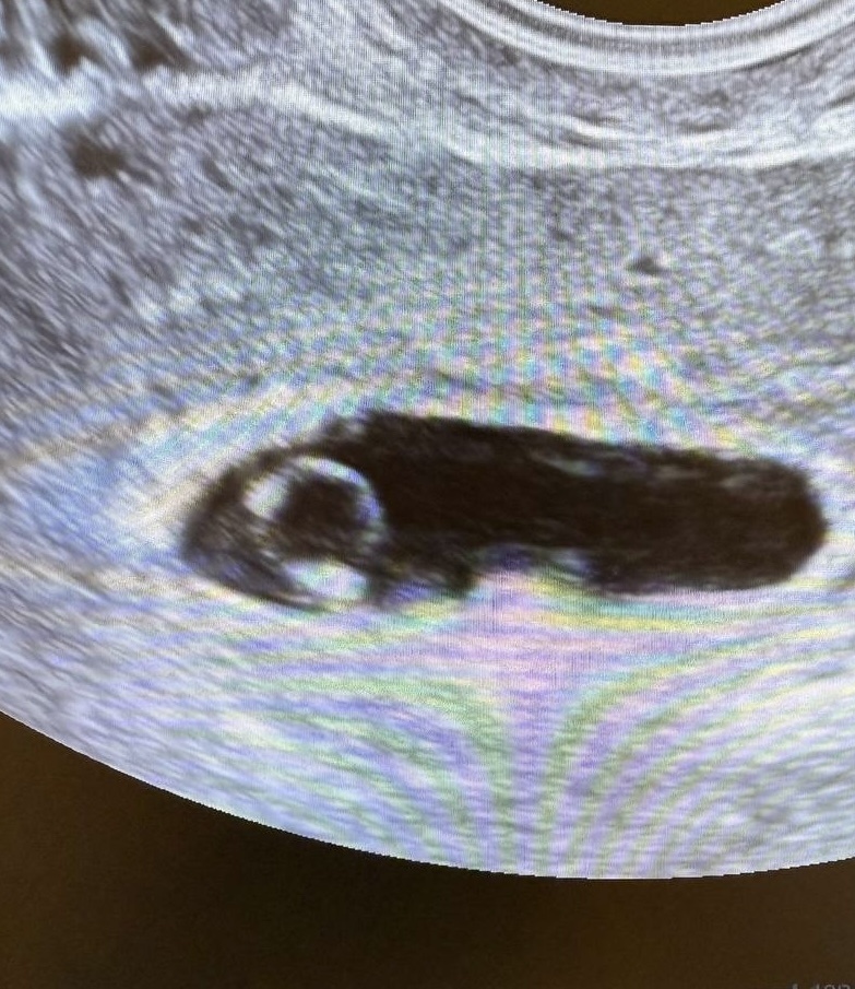 Беременность 6 недель. Желточный мешок в виде колечка, эмбрион — « бриллиант»