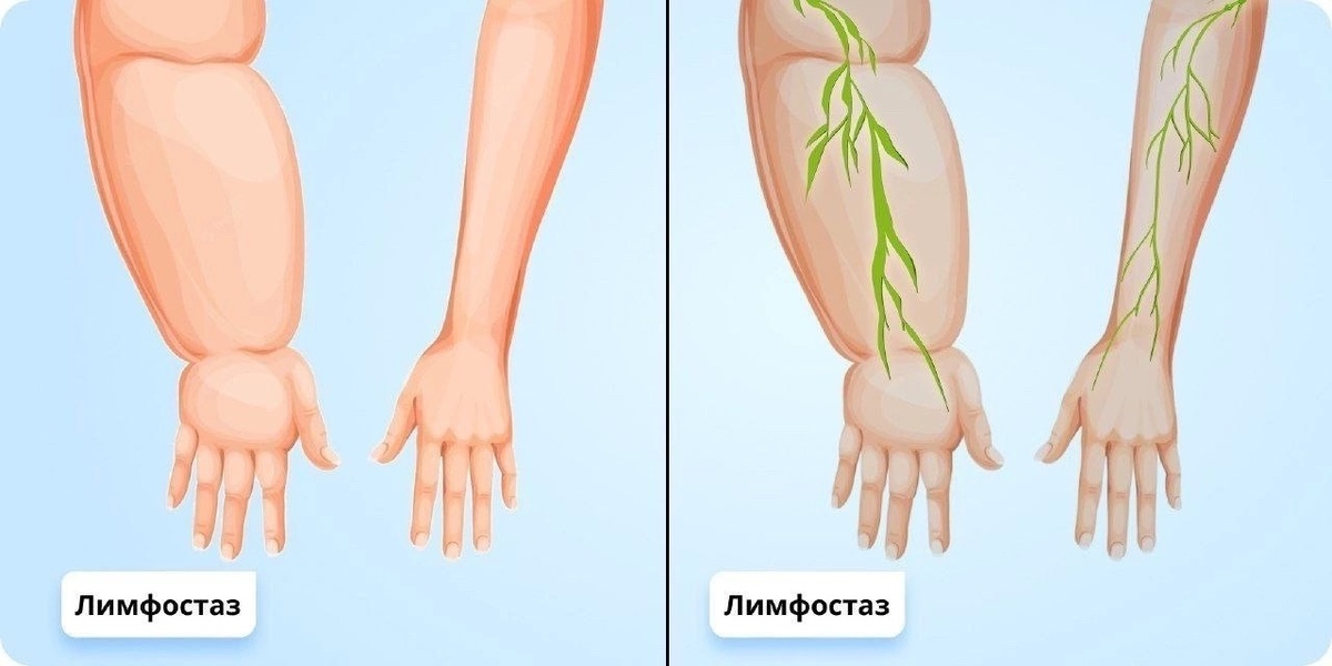 Симптомы лимфостаза: отёки и тяжесть, которые нарастают день ото дня