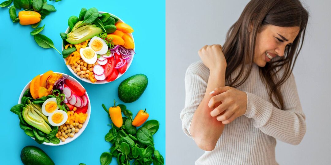 Псориаз и питание: продукты, которые ухудшают состояние кожи