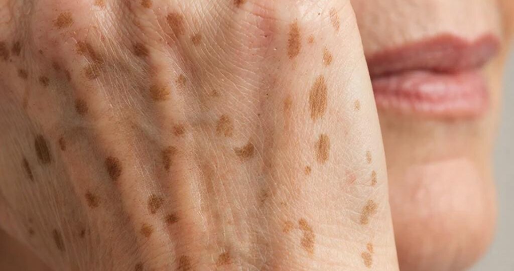 Пигментация после 50+: это не возраст, а накопленный «фотостаж». Почему пятна атакуют лицо и руки?