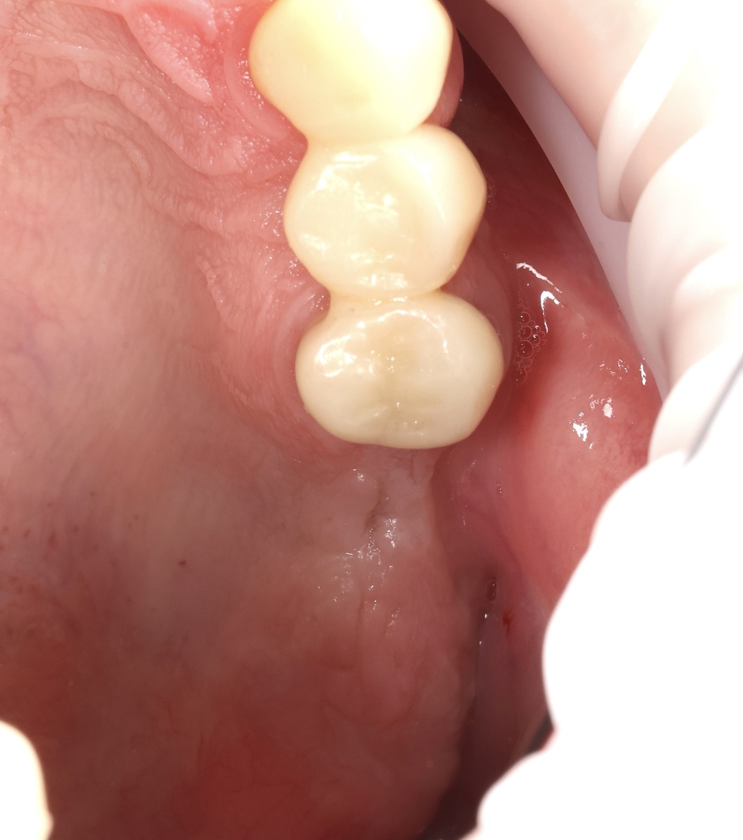 Отсутствие зуба 2.6