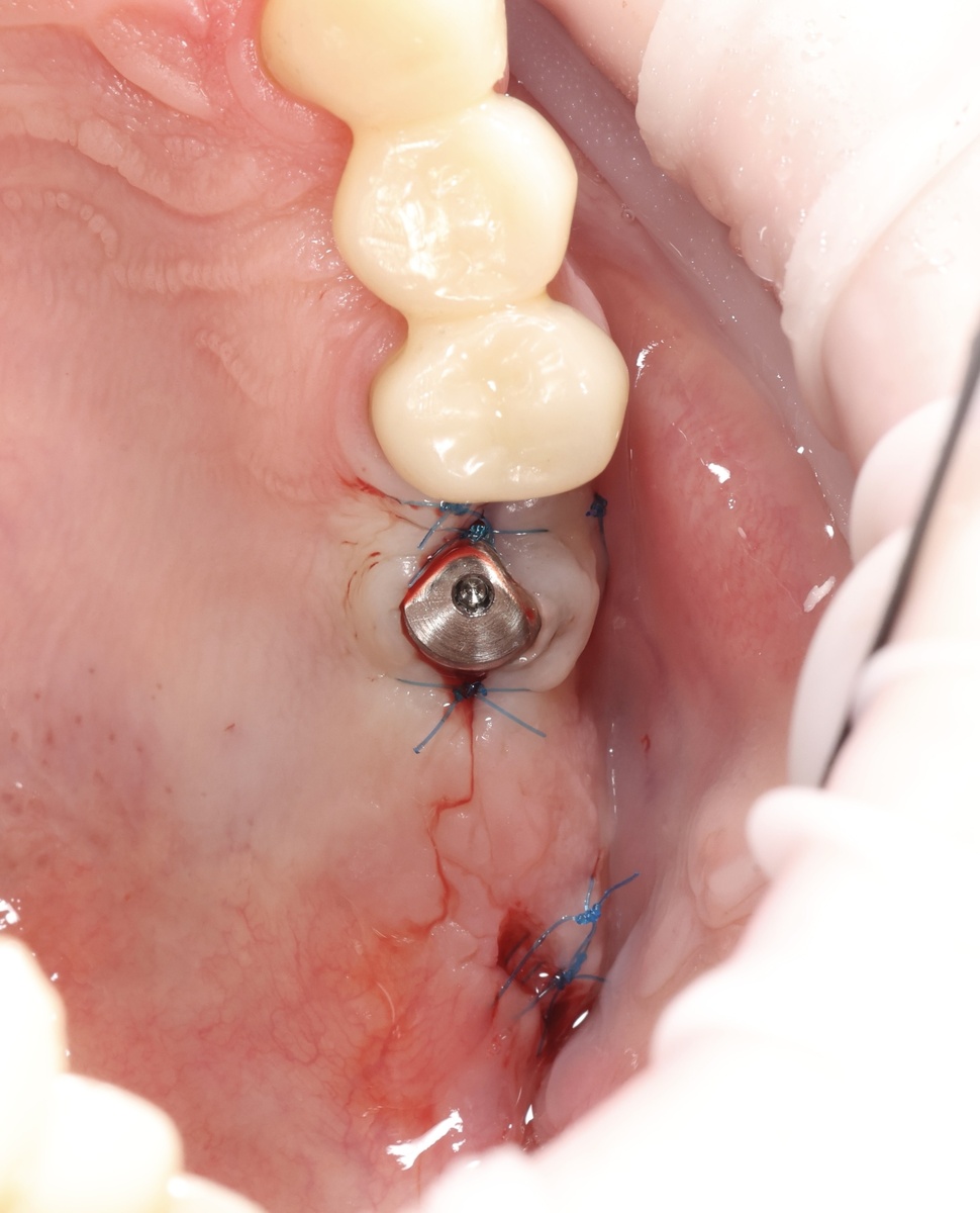 Имплантация в области 2.6 зуба