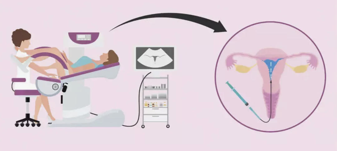 Непроходимость маточных труб — не приговор. Реальная история из практики