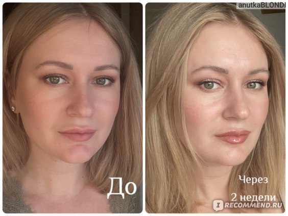 ссылка на источник - https://irecommend.ru/content/pervye-omolazhivayushchie-inektsii-dlya-litsa-v-31-god-rezultat-posle-ukolov-polimolochnoi-k