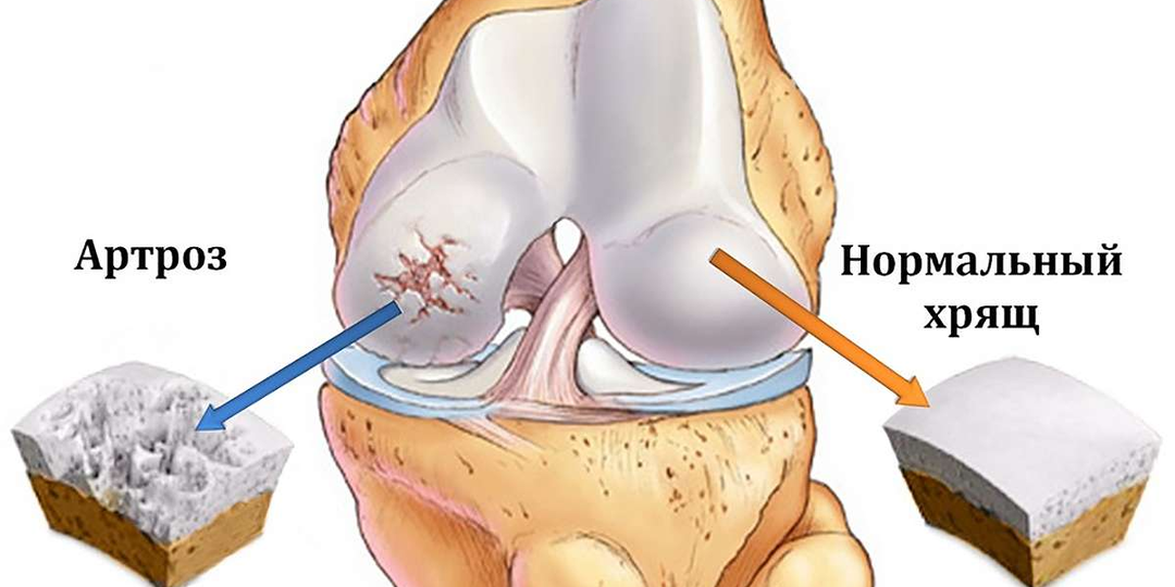 6 признаков, что суставы разрушаются изнутри (чек-лист)