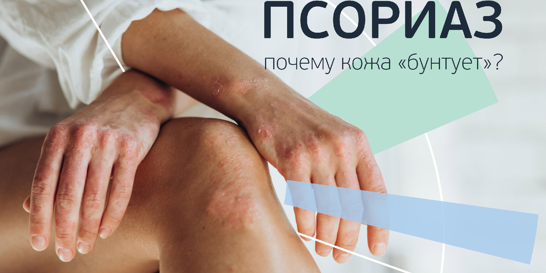 Псориаз. Почему кожа «бунтует», как взять болезнь под контроль.