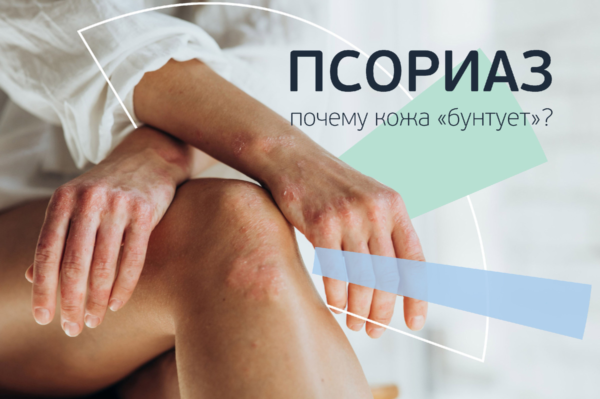 Псориаз. Почему кожа «бунтует», как взять болезнь под контроль. 