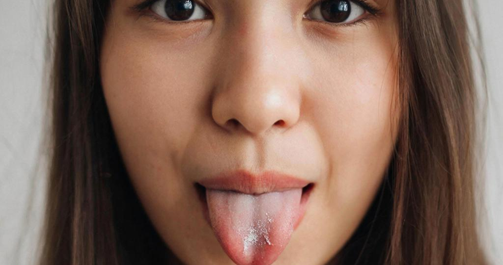 Язык — зеркало ЖКТ: налет, трещины, жжение — о чем они могут говорить