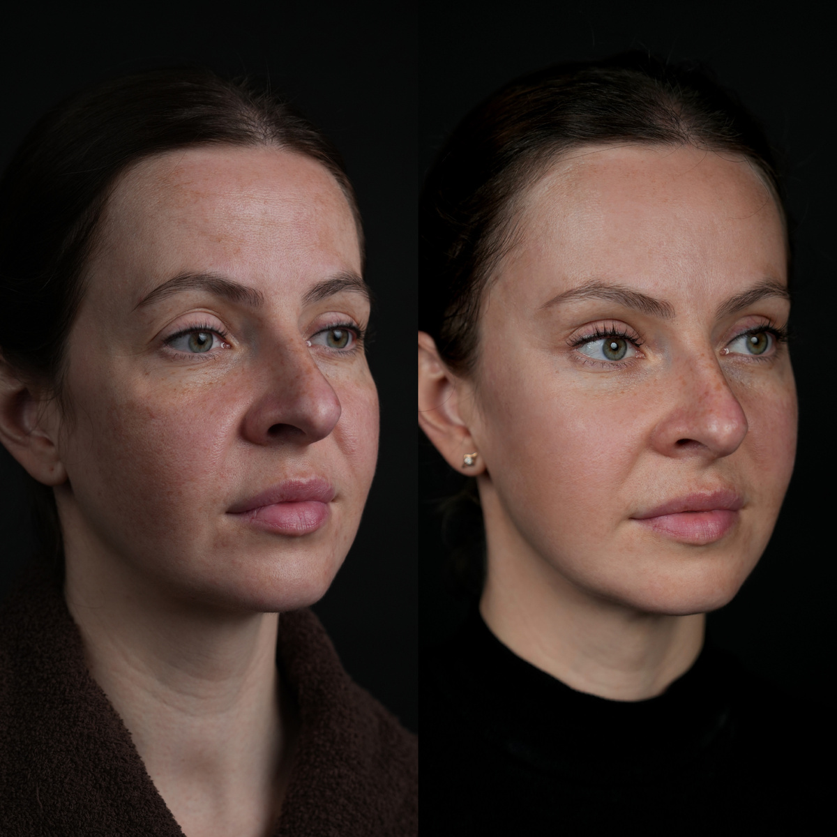 (Круговая блефаропластика 
SMAS лифтинг с платизмопластикой;