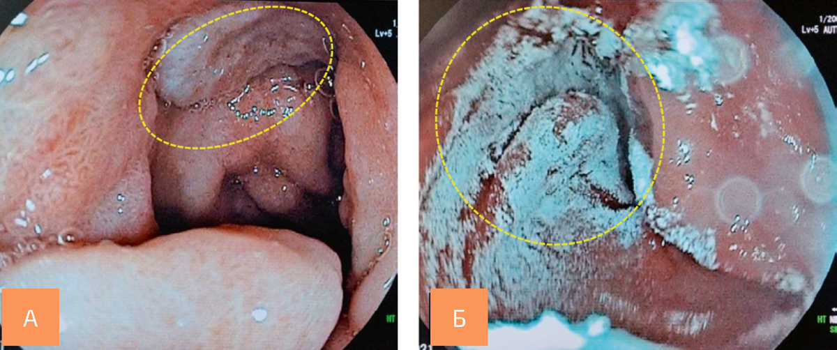 A — язвенный дефект передневерхней полуокружности луковицы двенадцатиперстной кишки (отмечено фигурой); Б — нанесение альгинатного полимерного полисахаридного гемостатического гидрогеля на язвенный дефект (отмечено фигурой)