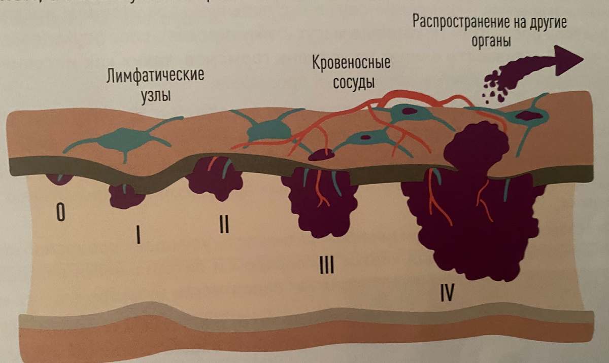 Личное фото. Стадии рака толстой кишки