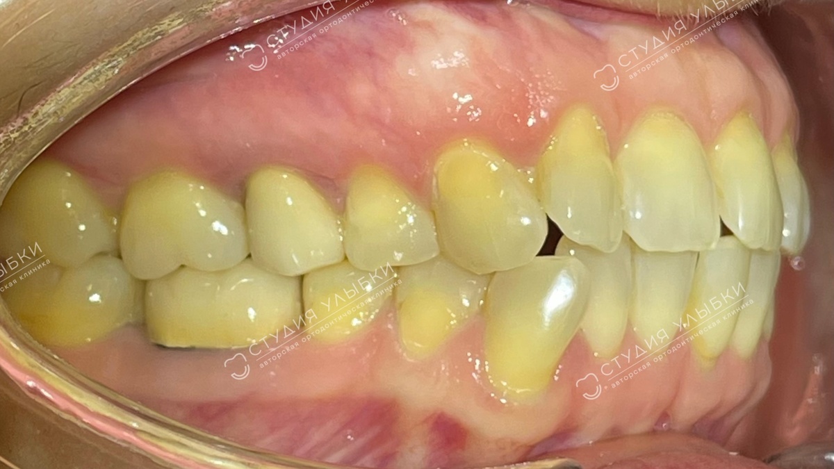 ФОТО: ДО ЛЕЧЕНИЯ. 43 года, средняя скученность зубов. Листайте галерею, чтобы увидеть больше фото.