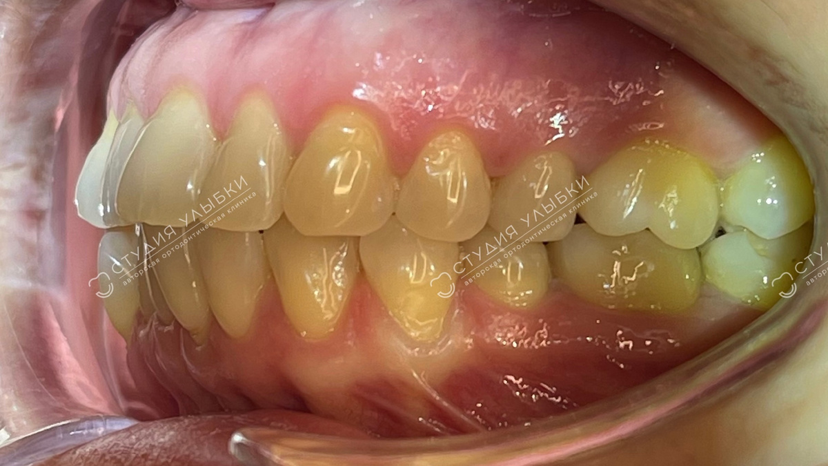 ФОТО: ДО ЛЕЧЕНИЯ. 43 года, средняя скученность зубов. Листайте галерею, чтобы увидеть больше фото.