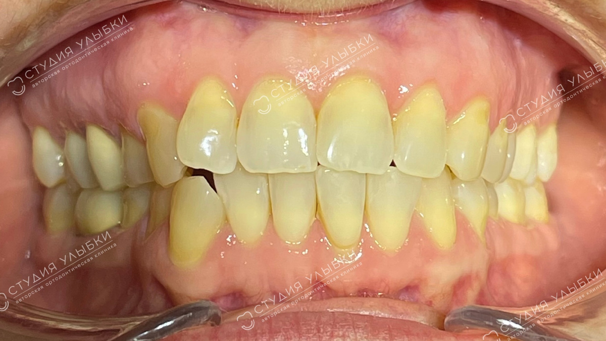 ФОТО: ДО ЛЕЧЕНИЯ. 43 года, средняя скученность зубов. Листайте галерею, чтобы увидеть больше фото.