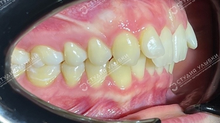 Дистальный прикус до ортодонтического лечения. Листайте галерею, чтобы увидеть ббольше фотографий.