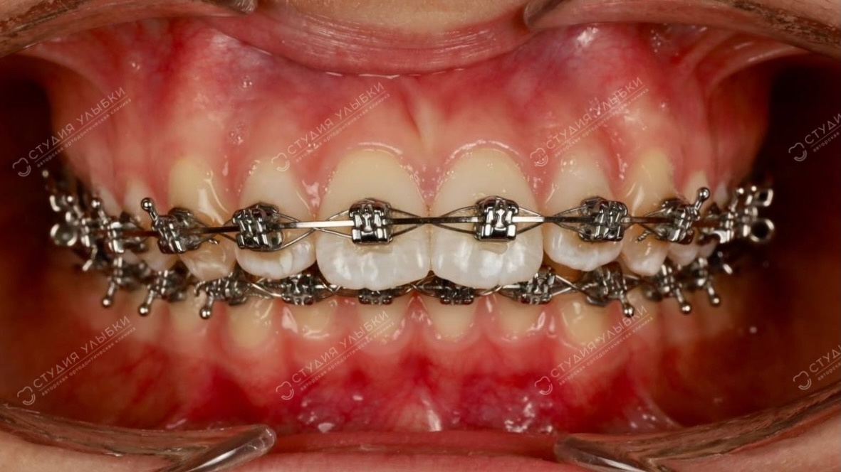 Металические брекеты. Листайте галерею, чтобы увидеть больше фото. 