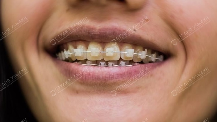 Керамические брекеты. Листайте галерею, чтобы увидеть больше фото. 