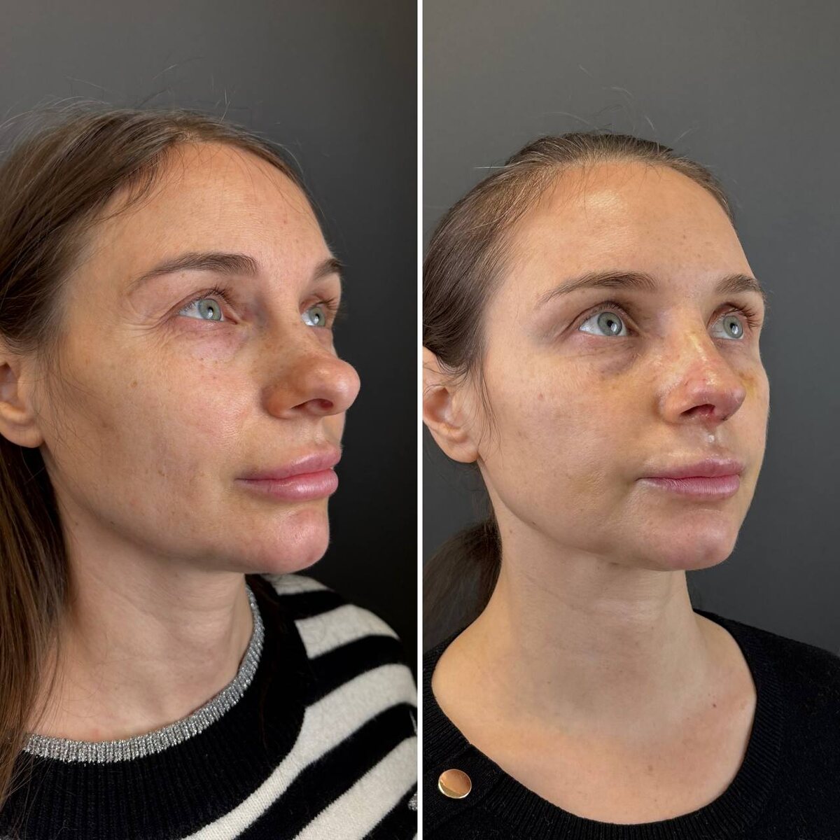 Ринопластика: 10-е сутки после операции. Хирург к.м.н. Остринская Т.В.