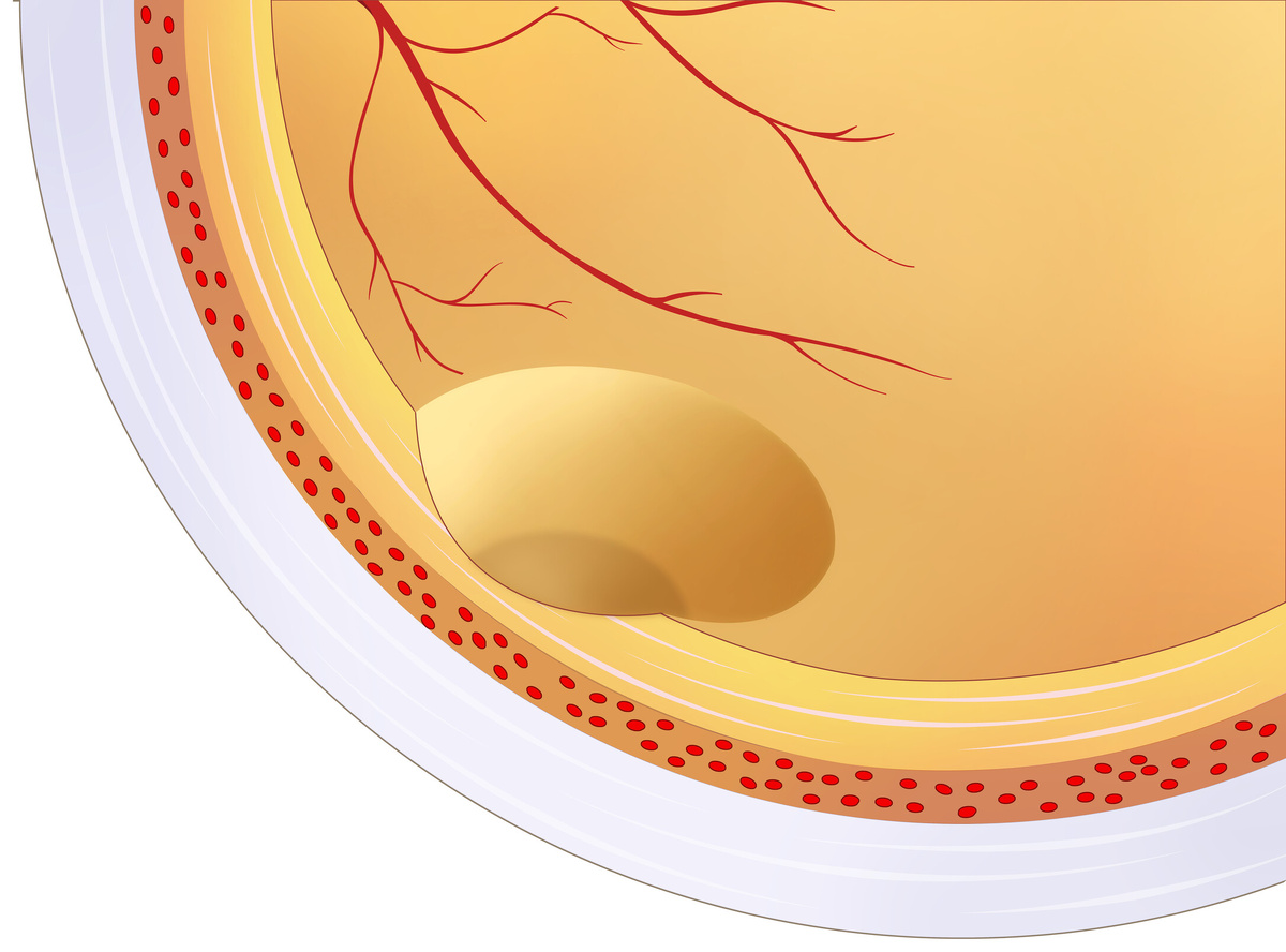    Желтое пятно также называется макулой.Legion-Media