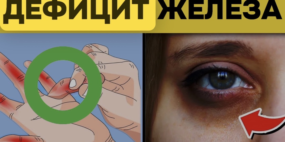 Ферритин 14: почему гемоглобин не главный показатель