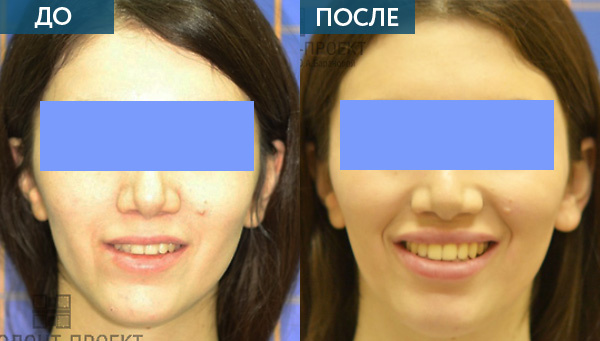 Исправление прикуса зубов До и ПОСЛЕ