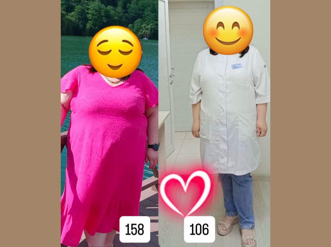 После бариатрической операции