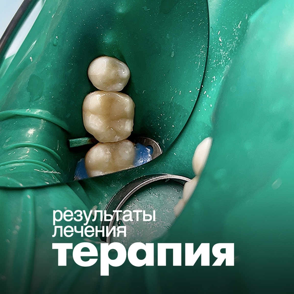 Лечение кариеса зуба 4.6