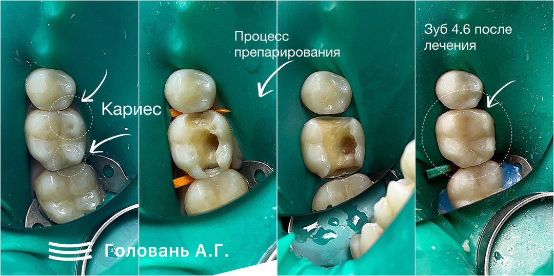 Как распознать кариес?