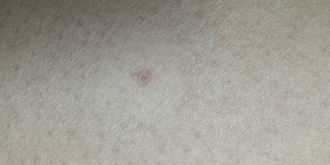 Появились сухие пятна на коже: о чём сигнализирует организм