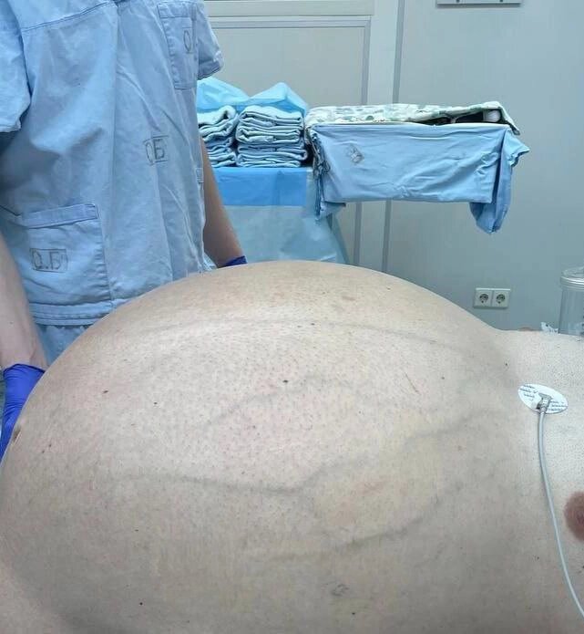    С такой огромной опухолью хирурги имели дело впервые. Фото: Минздрав Свердловской области
