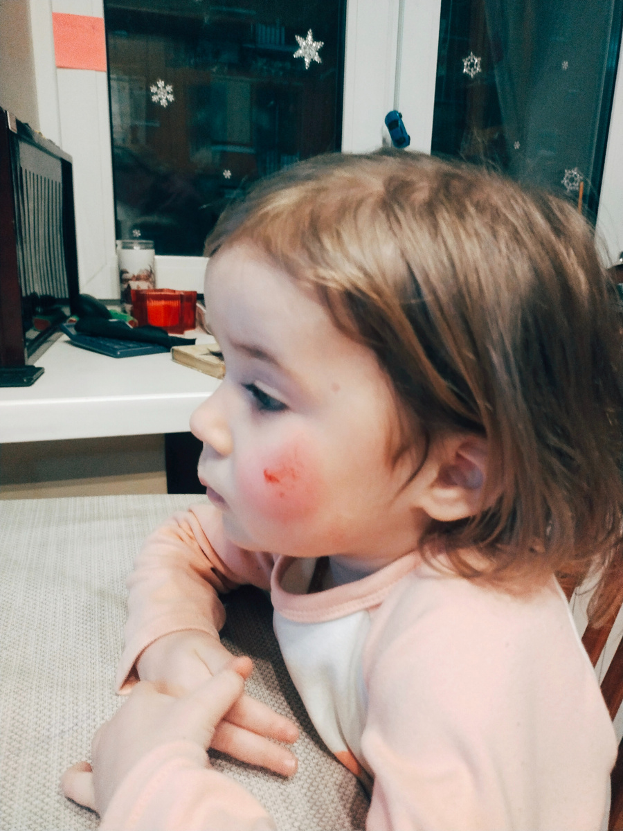 Мира - это катастрофа. Всегда найдёт, где упасть и что ободрать 