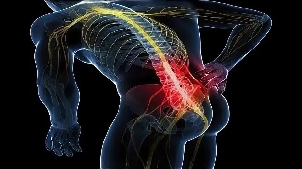 Болит спина, защемлен седалищный нерв? Личный опыт, как облегчить боль.