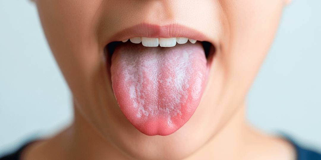 Белый налет на языке: причины, диагностика и когда обращаться к врачу