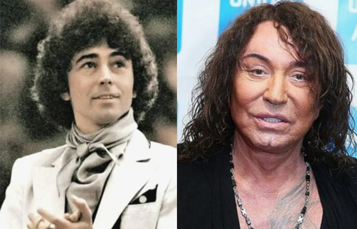 Валерий Леонтьев делал несколько неудачных процедур.