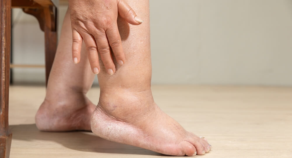 Плотные отеки ног, которые не уходят после отдыха. Лимфедема: как запустить «засорившуюся» лимфатическую систему