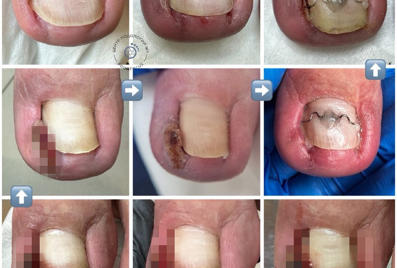 Вросший ноготь: скальпель хирурга или кабинет подолога?