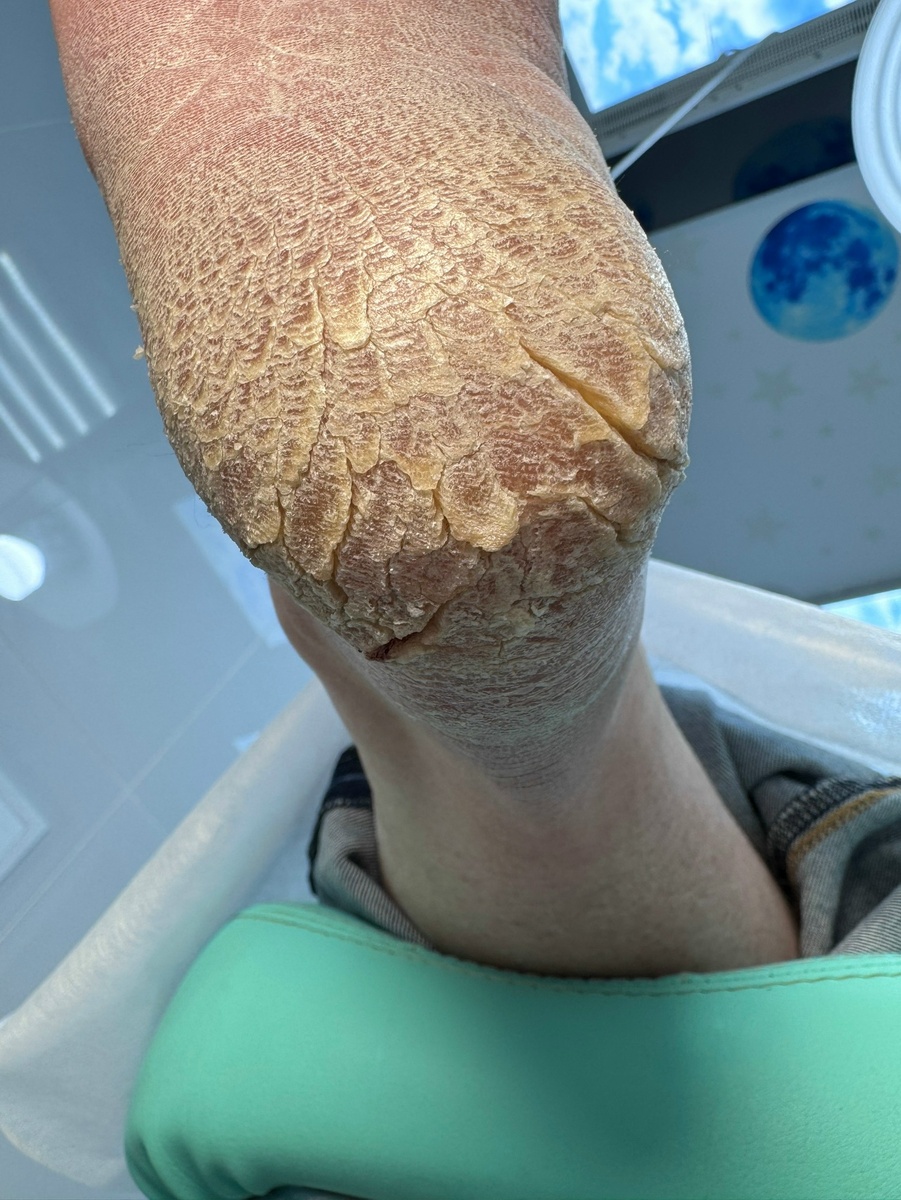 Ноги в небе или как экономить на педикюре
💡Проблема :
✅Трещины на пятках
✅Некомфортно так жить
✅Пятки цепляются за простынь , носки , ковер
✅Стыдно одеть открытую обувь
✅Нет особо лишних денег на постоянные походы на педикюр
💡Желание :
✅Иметь идеально гладкие пятки и уверенность в своем теле
Решение :
✅Сходит всего один раз на качественную зачистку
✅Пользоваться еврофут кремом 2-3 раза в день
💡Итог :
Сейчас или ни когда ! Откладывать смысла нет ! Сделайте хоть что-то именно для себя !
‼️Если хотите знать каким кремом я пользовалась , напишите «хочу узнать крем» и я вам его пришлю
( пжл помните что вы должны быть на меня подписаны так как больше 20 сообщений вк блокирует в день )
Динамики можно посмотреть тут 
https://t.me/libraryfungus

Посмотреть препарат можно тут  
https://www.ozon.ru/brand/eurofoot-100124126/

Записаться на консультацию:
+7 985 489-45-86

Наш сайт g2f.ru

MAX https://max.ru/podologeva