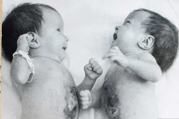 Сиамские близнецы — Анна и Татьяна Коркины. Фото: предоставлено для публикации hornews.com