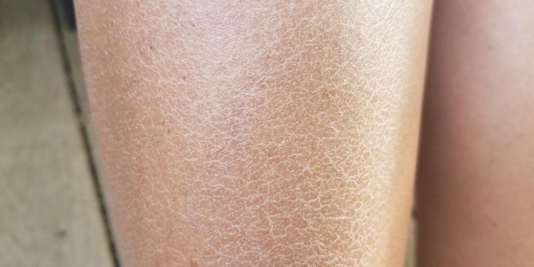 Зуд кожи без сыпи: скрытые причины, о которых не думают