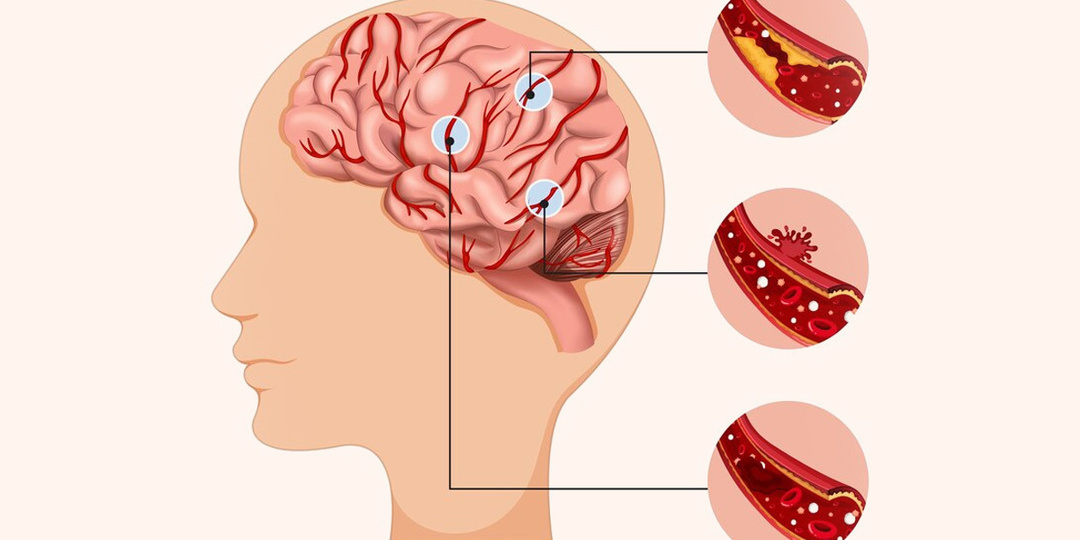Сосуды мозга стареют быстрее возраста: как это проявляется сначала