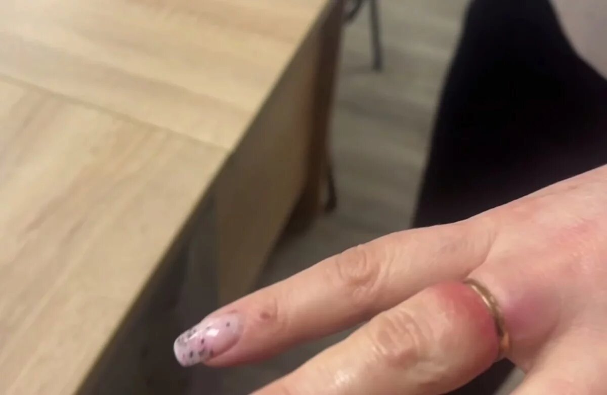    Спасатели сняли с биробиджанки золотое кольцо, сдавившее палец после ожога