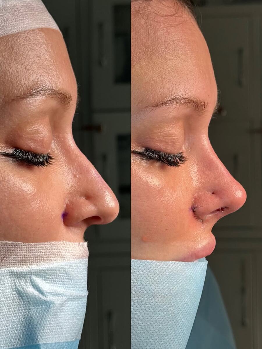 Результат риноспетопластики в исполнении Дирксена Петра Викторовича