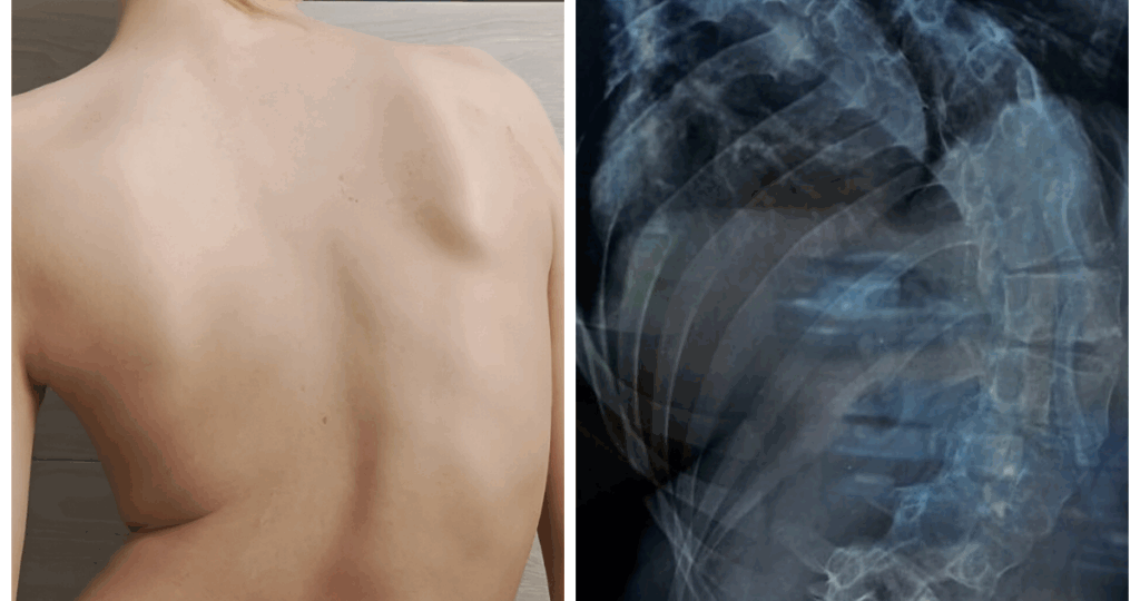 Сергею нужно исправить сколиоз IV степени. Внутренние органы встанут на место, не будут сдавлены, восстановится их нормальная работа.