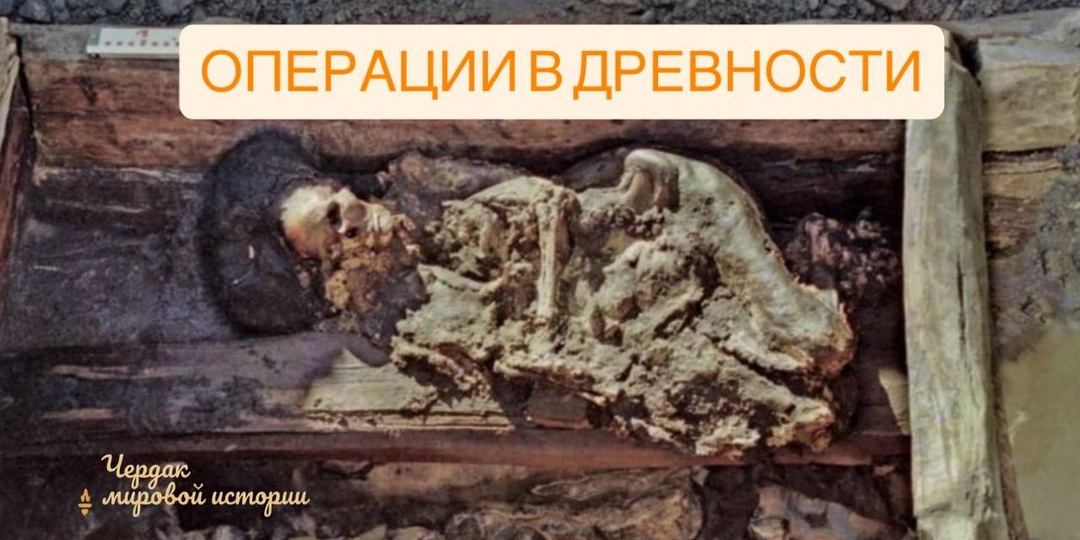 Ей сделали операцию на челюсти — 2300 лет назад. Кто были хирурги Алтая?
