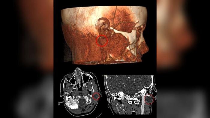 Врачи успешно удалили редчайшую кисту у ребёнка, сохранив мимику лица. Фото © VK / Российская детская клиническая больница (РДКБ)