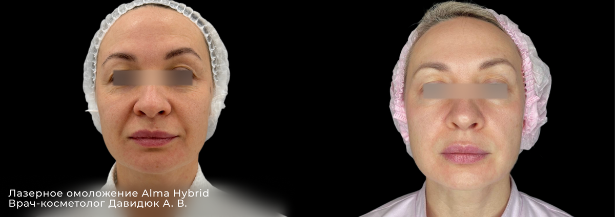 Лазерная шлифовка Альма Гибрид | клиника косметологии GEN87