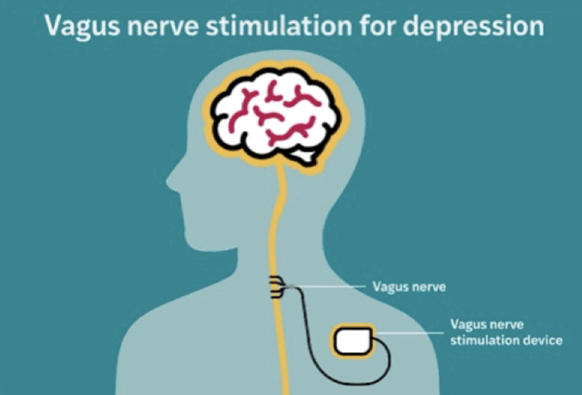    Имплант, стимулирующий блуждающий нерв, обеспечил длительное облегчение людям с наиболее тяжелой, устойчивой к лечению депрессией.