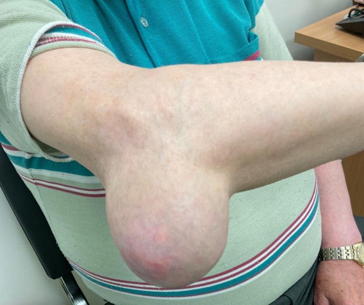 Скопление кристаллов мочевой кислоты в локтевом суставе